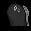 SPORK, NICO - 22.03.1976 - 02.08.2022 - CT obere Extremität - 18:01:28